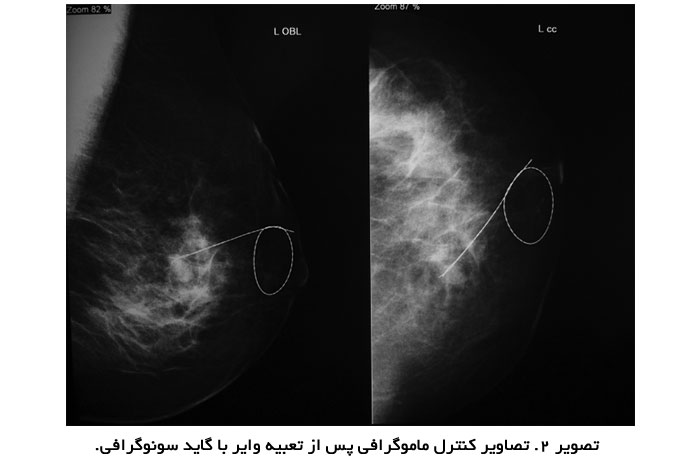تصاوير کنترل ماموگرافی پس از تعبيه واير با گايد سونوگرافی